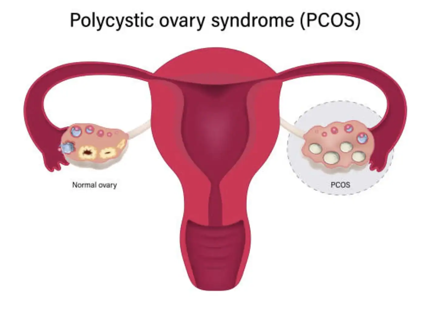 Sindrom policističnih jajčnikov (PCOS)